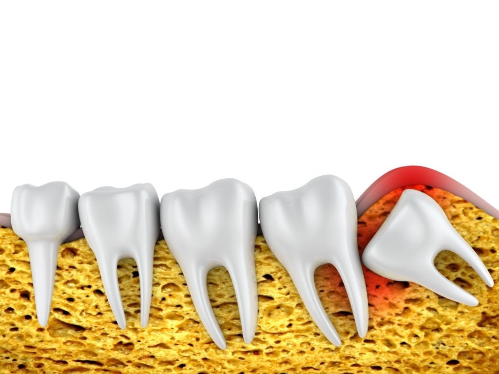Dental row of molars and an improperly located wisdom tooth. 3d rendering.