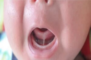Tongue Ties in Children