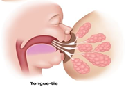 breastfeeding and tongue tie Copy