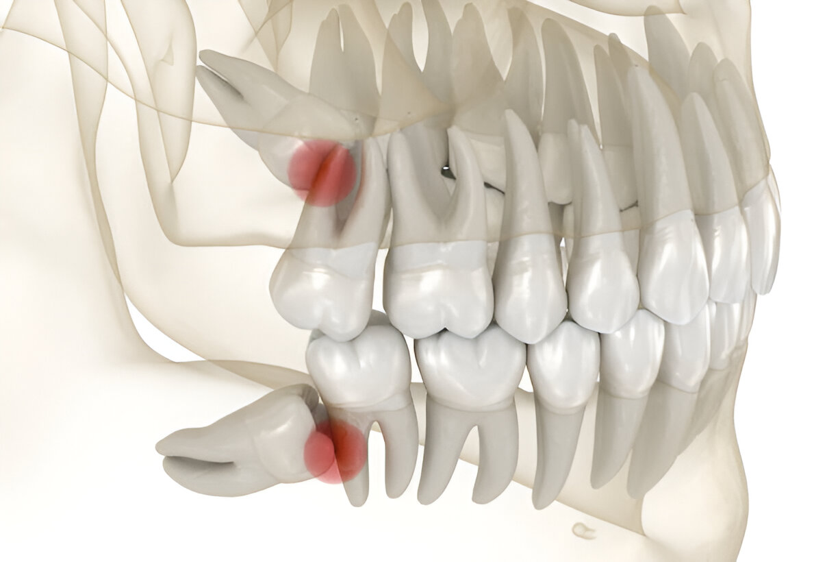 Wisdom Teeth Removal Surgery