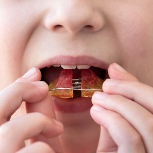 Close-up young boy applying retainer orthodontic appliance. Health care or dental hygiene concept. Soft focus