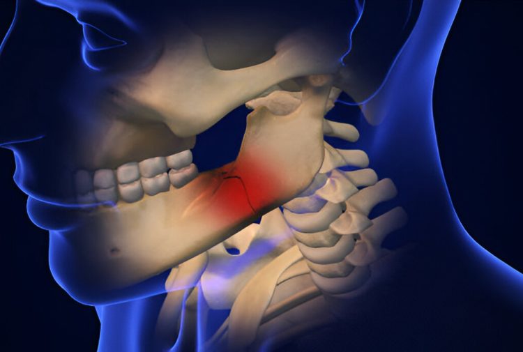 FACIAL/JAW FRACTURES